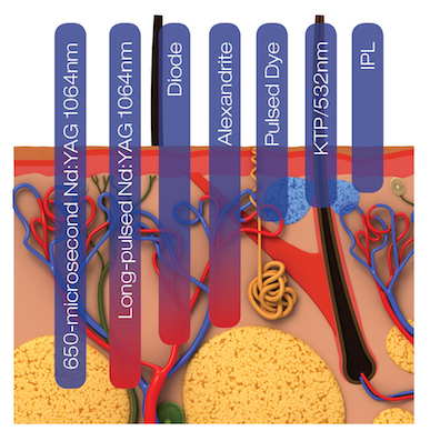 Laser Penetration Attraction | The Liftbar MedSpa