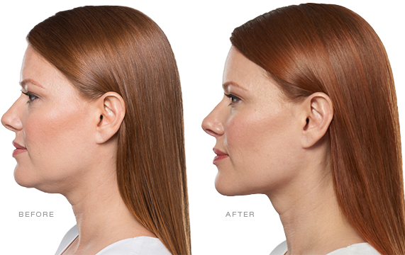 Kybella Treatment near me