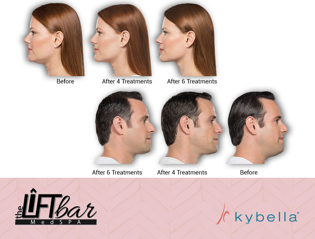 kybella before and after