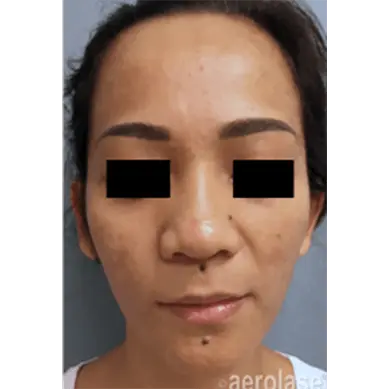 after Acne treatment
