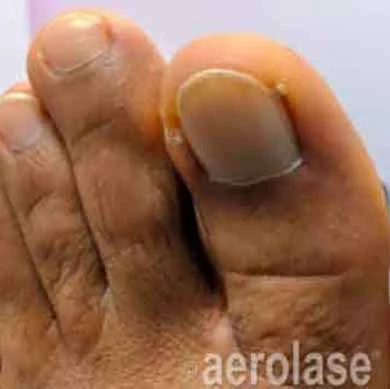 Laser Nail treatment