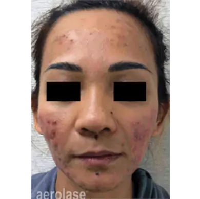 before Acne treatment