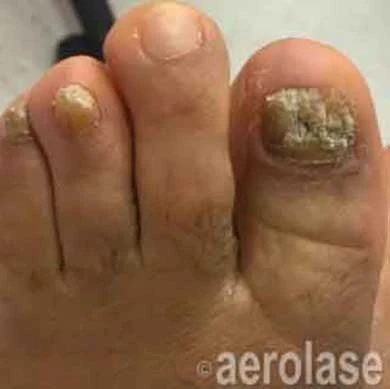 Painless nail treatment near me