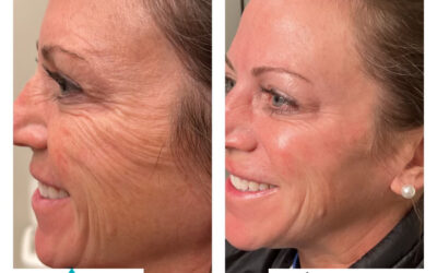 Unlocking Youthful Radiance with Skinvive by Juvederm at The Lift Bar Medspa, Nicholasville KY