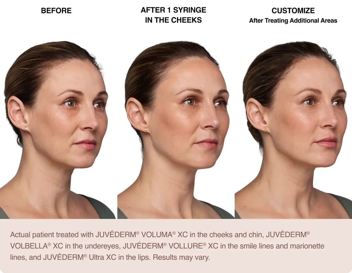 Actual patient treated with Juvederm | The Lift Bar Actual patient treated with Juvederm