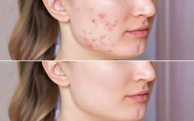 Acne Treatment with The Neo Elite No-touch Laser