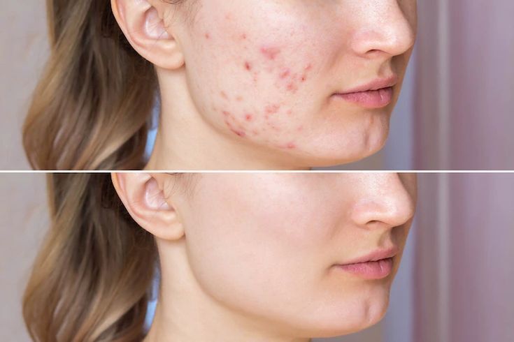 Acne Treatment