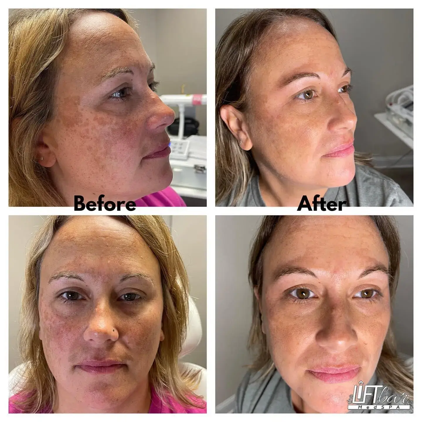 anti aging treatment
